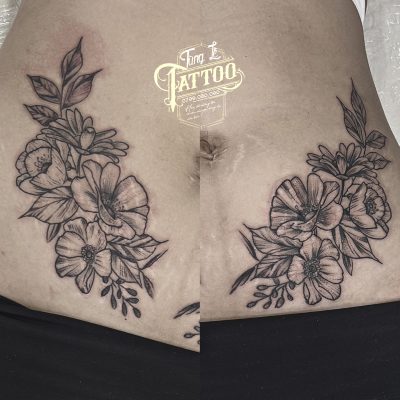 Che thẹo rạn bụng tại tùng lê tattoo